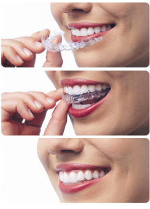 invisalign-pros-and-cons